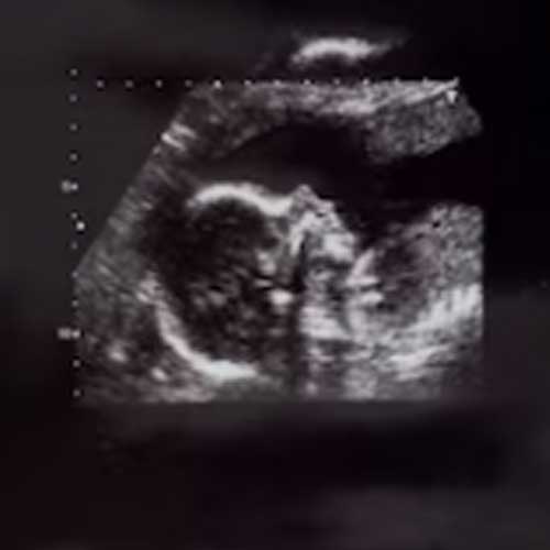 kehamilan ektopik diatasi dengan laparoskopi
