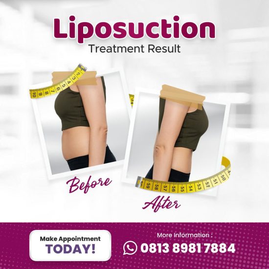 Hasil Liposuction atau Sedot Lemak RSIA BINAMEDIKA